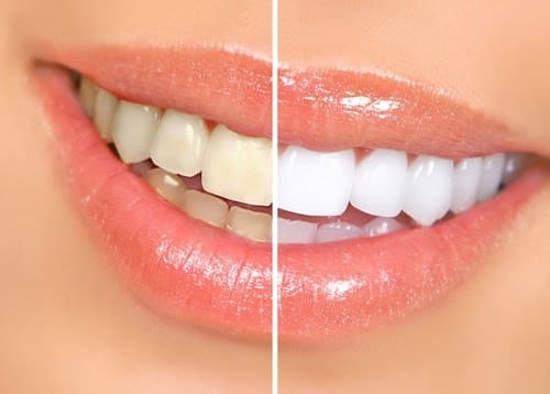Teeth Whitening Orlando, Florida | Mosaic Dental Center