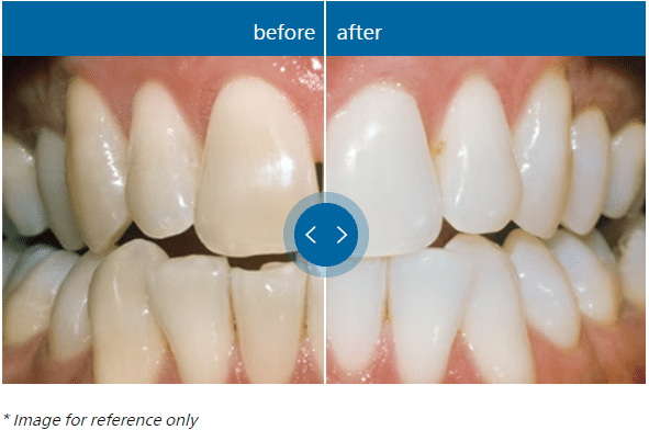 ZOOM TEETH WHITENING