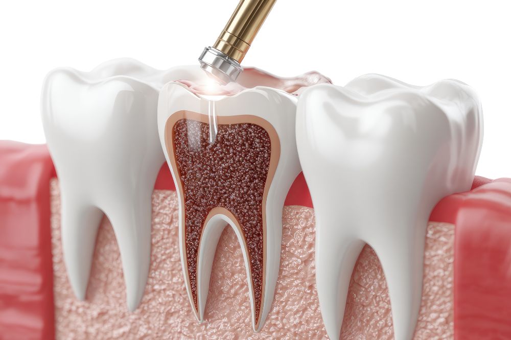 Understanding dental fillings