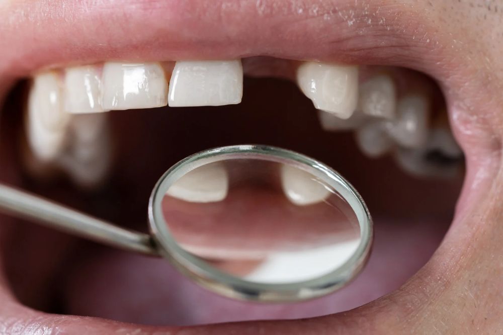 the Importance of Restorative Dentistry for Damaged or Missing Teeth - Mosaic Dental Center The importance of restorative dentistry for damaged or missing teeth